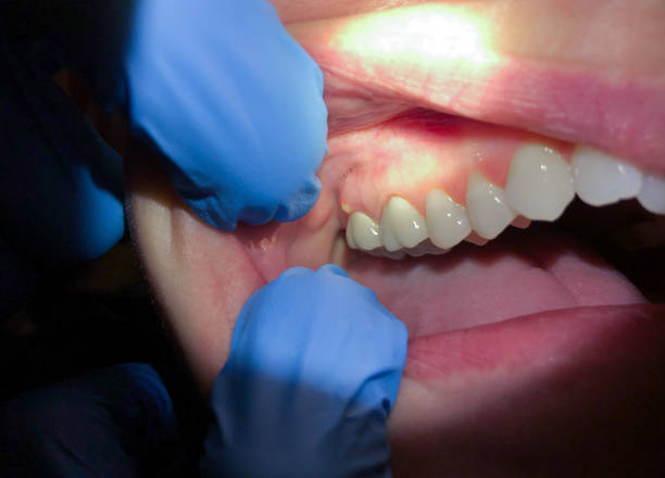 Best Urgent Care for Lost Fillings or Crowns in Salem, NC