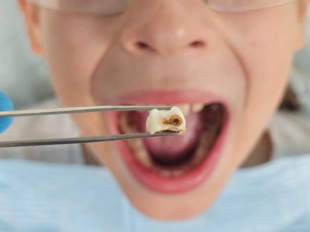 Best Emergency Dental Care for Broken or Chipped Teeth in Salem, NC